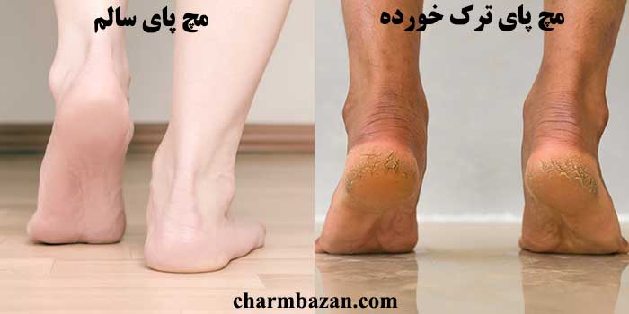 برای رفع ترک پاها چه کنیم؟ _ charmbazan